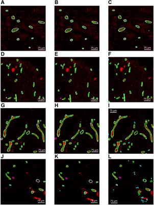 Deep learning-based automated pipeline for blood vessel detection and distribution analysis in multiplexed prostate cancer images